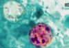Health Alert: 2 dead, 18K cases reported in cyclosporiasis outbreak