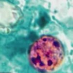 Deadly Lettuce? One State Sounds Alarm Health Alert: 2 dead, 18K cases reported in cyclosporiasis outbreak