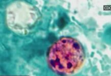 Health Alert: 2 dead, 18K cases reported in cyclosporiasis outbreak